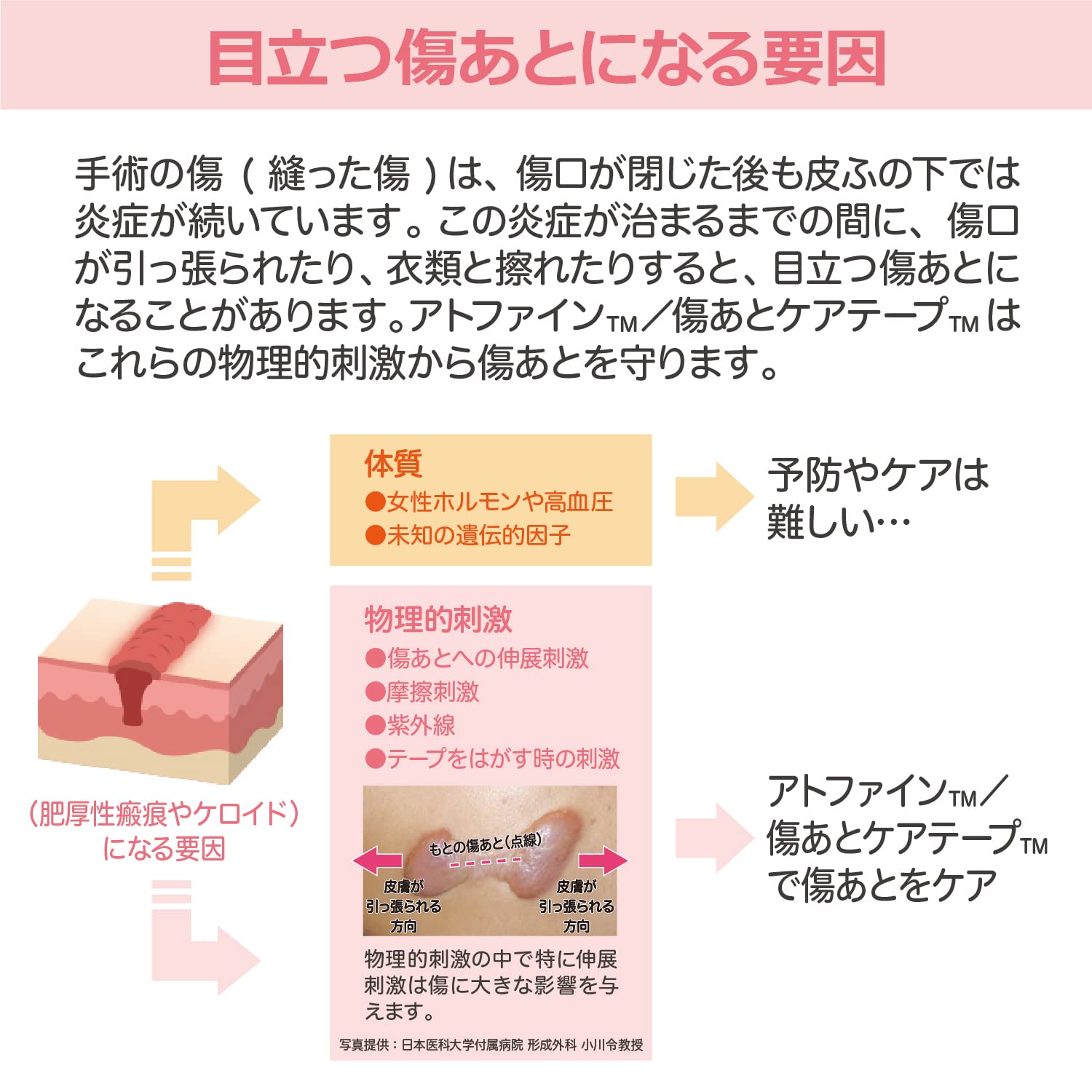【니치반】아토파인 상처 후 케어 용품 제왕 절개 케어 상처 후 케어 테이프 L사이즈 50 mm×164 mm ATFL