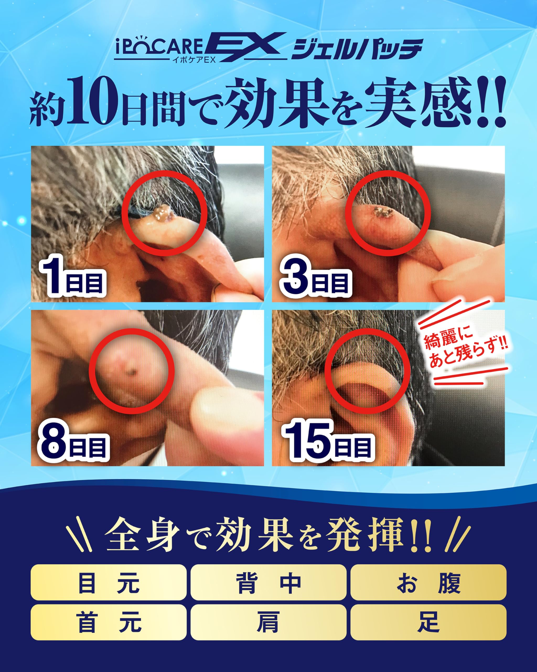 이포 케어 EX 젤 패치 25g 수원 얼굴 데코르테 용 젤 팩 의약 부외품 각질 케어 살리실산 하텀기 추출물 배합 일본제